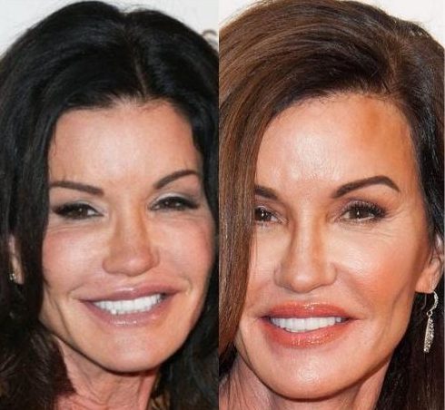 Celebrity Veneer