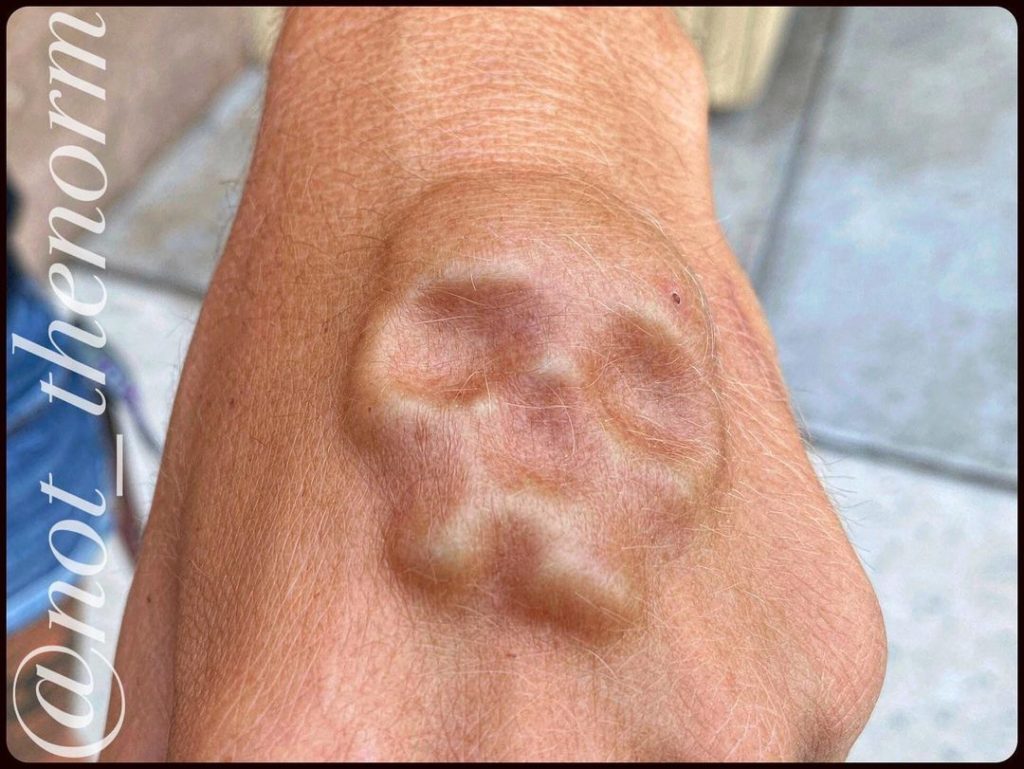 What is Subdermal Implant? Body Art Guru