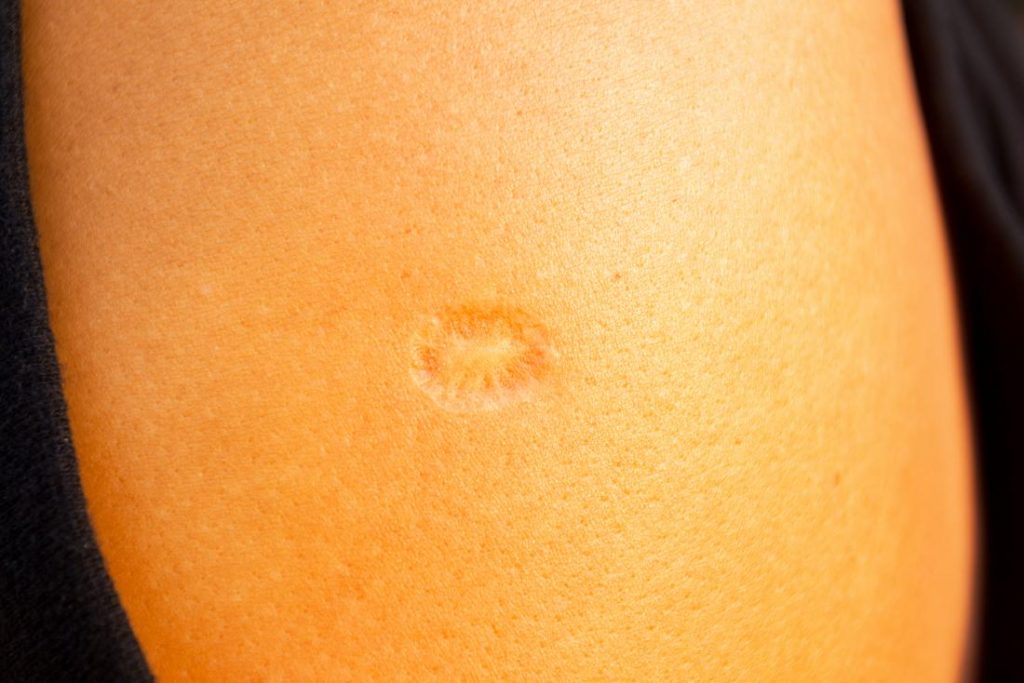 What is Injection Scarification? - Body Art Guru