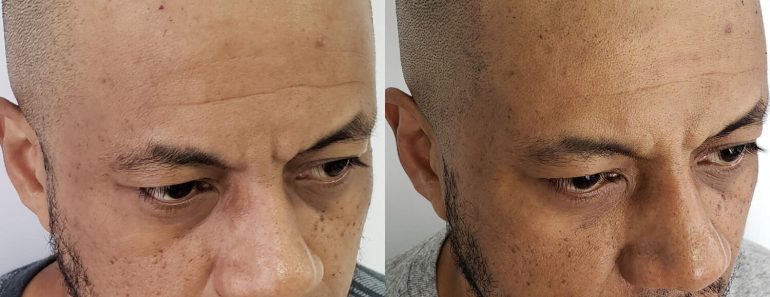 Tattoos For Hiding Scars: Scar Camouflage