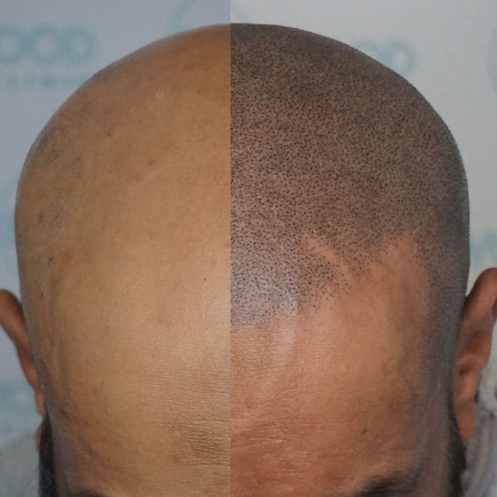 Scalp micropigmentation