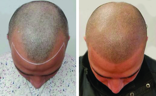 scalp micro pigmentation